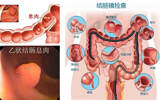 大便拉完以后一擦出血